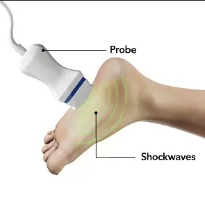 plantar fasciitis treatment