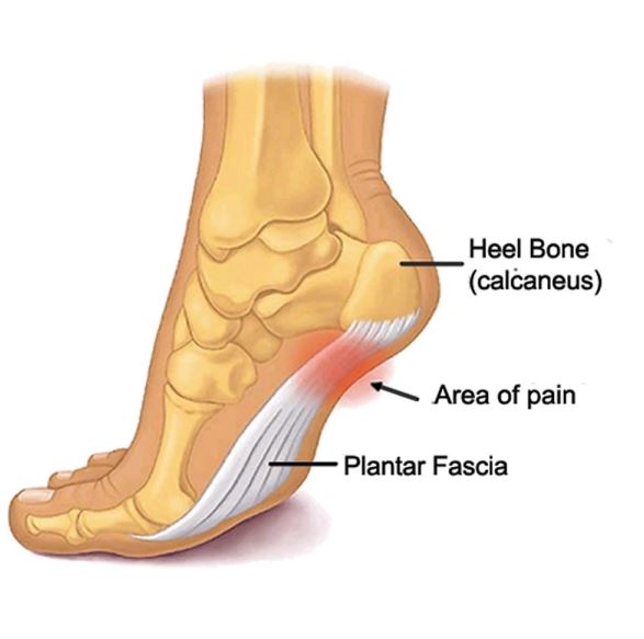plantar fasciitis heel pain 