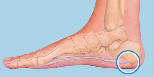 heel spurs heel pain