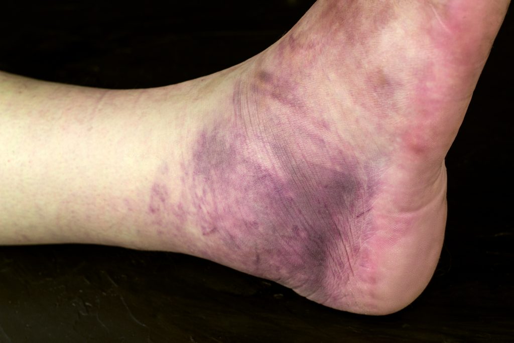stone bruise heel pain