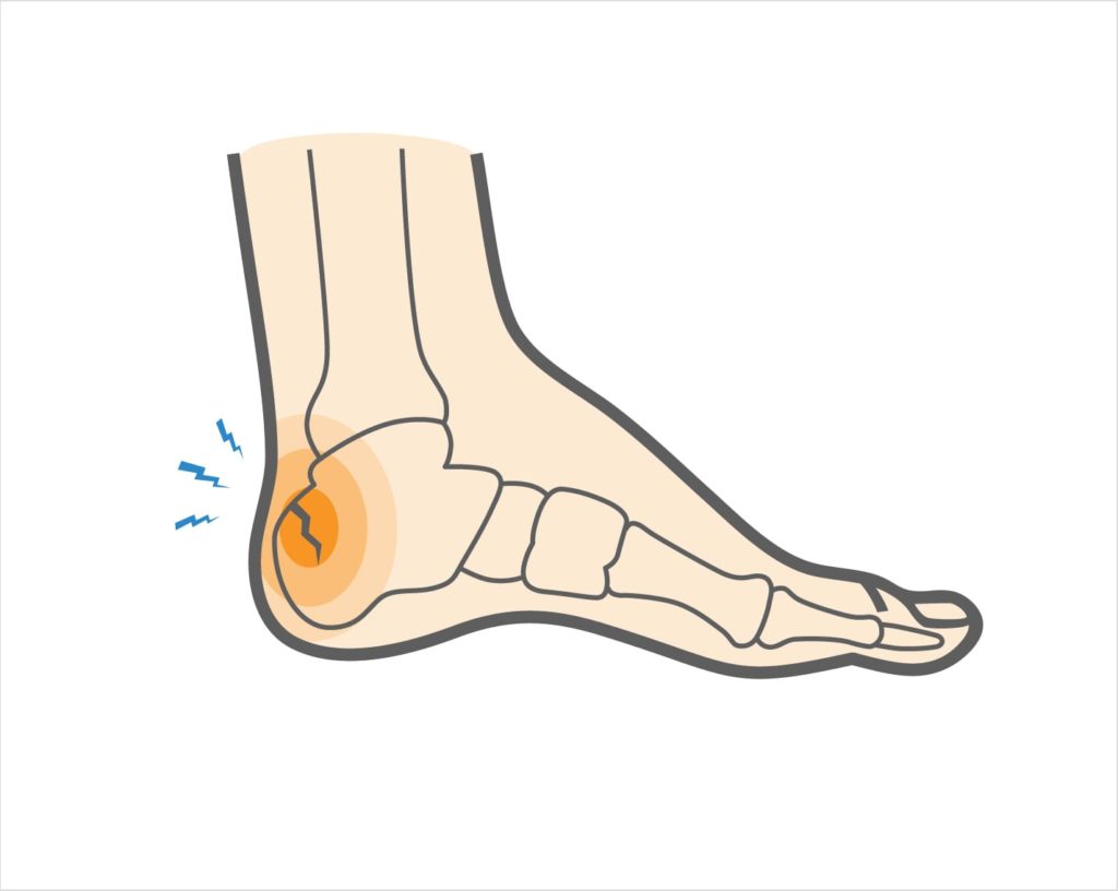 heel fracture heel pain