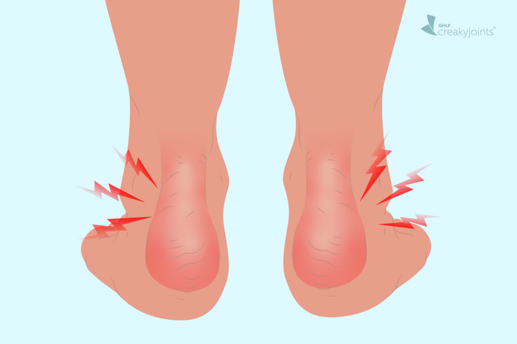 psoriatic arthritis heel pain