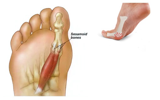 sesamoiditis heel pain