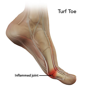 toe pain