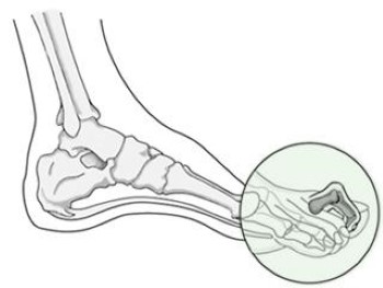 claw toe