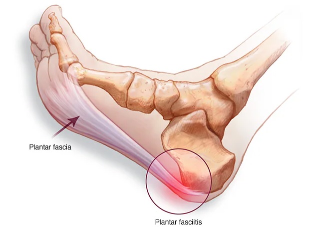 A drawn/visual representation of plantar fascia and plantar fasciitis