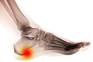 An X-ray of feet showing the heel spur