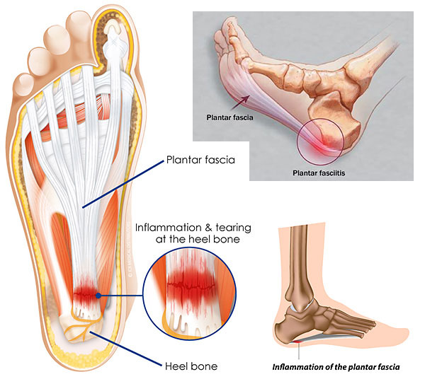 plantar fascia anatomy, plantar fasciitis 