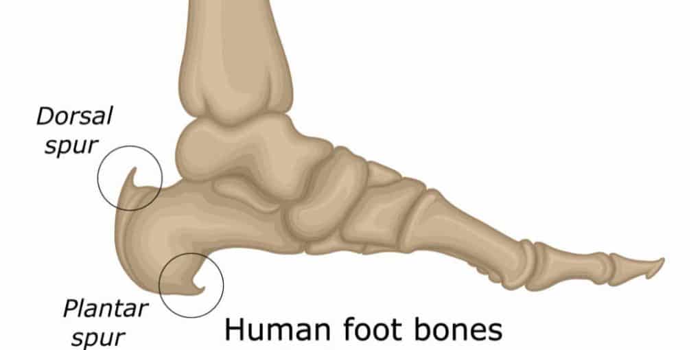 heel spur example img