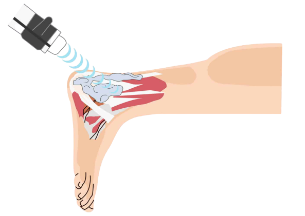 Extracorporeal shockwave therapy (ESWT)