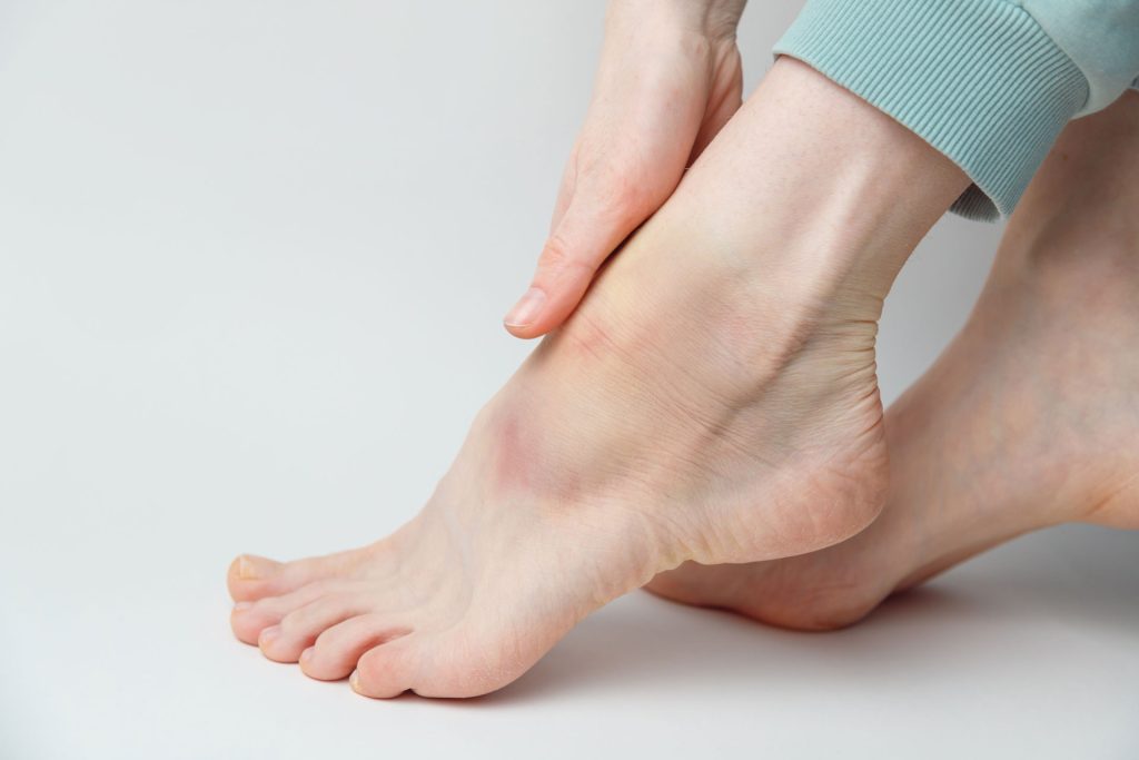 Sprained foot of a woman.
