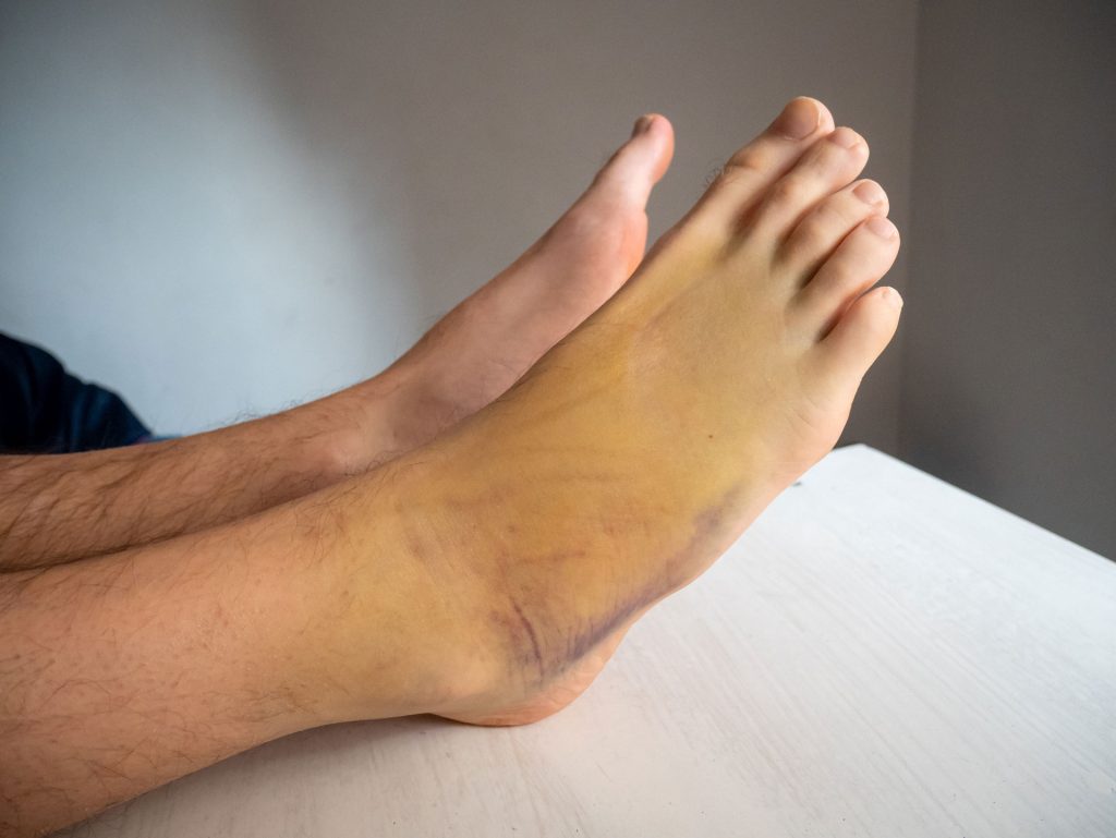 Right feet bruised.