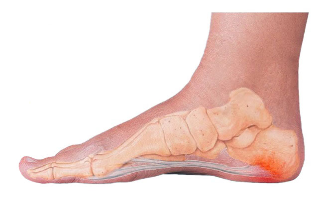 plantar fasciitis 