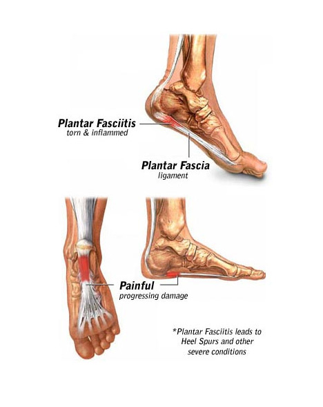 plantar fasciitis anatomy