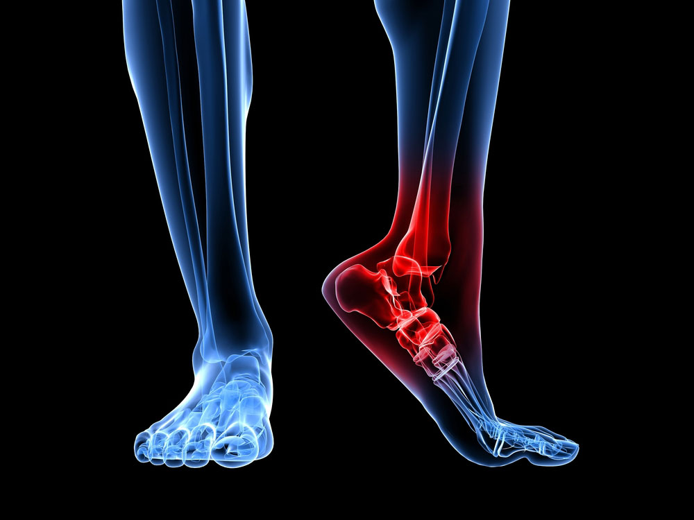 plantar fasciitis
