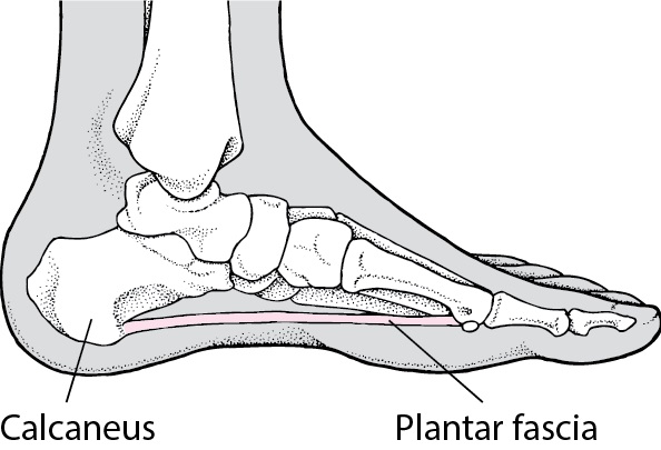 where plantar fasciitis occur