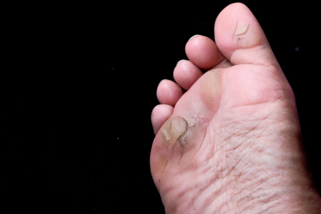 Close up photo of a dry foot.