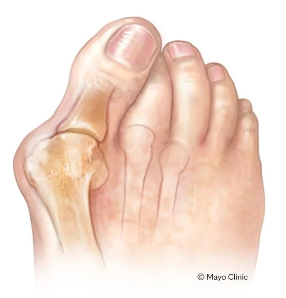 A photo representation of bunions.