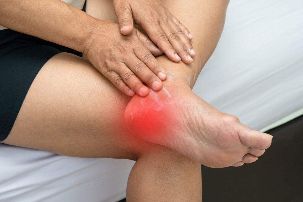 woman alleviating the severe heel pain, woman putting cream on her heel