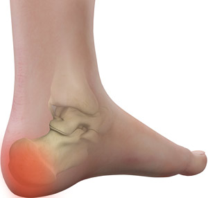 heel pain