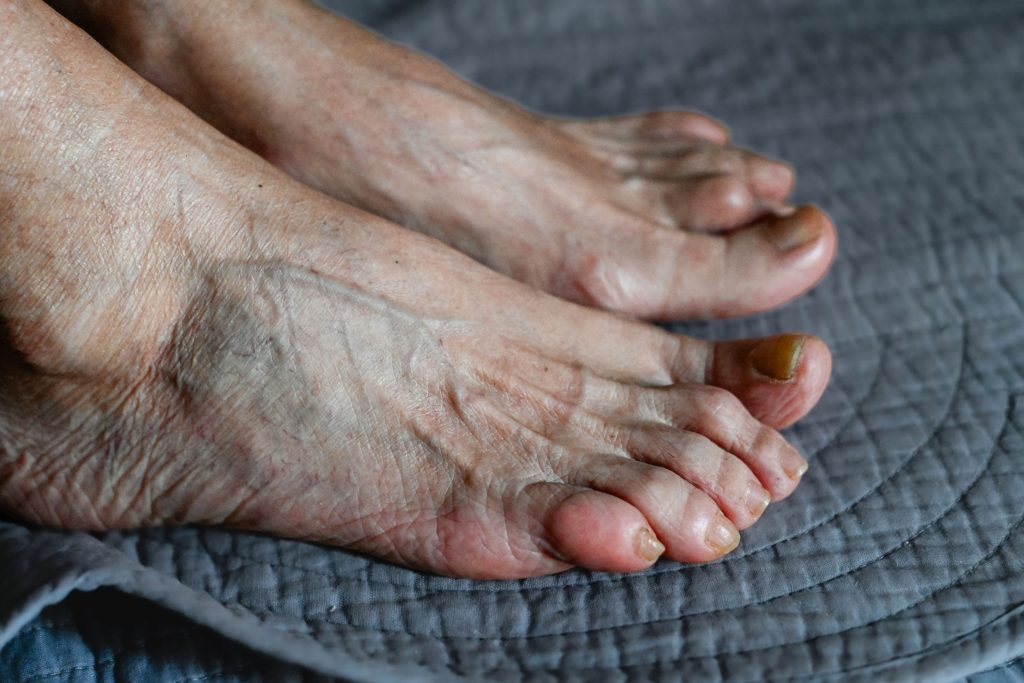 Close-up photo of elder's feet with gout to be treated by regenerative medicine.