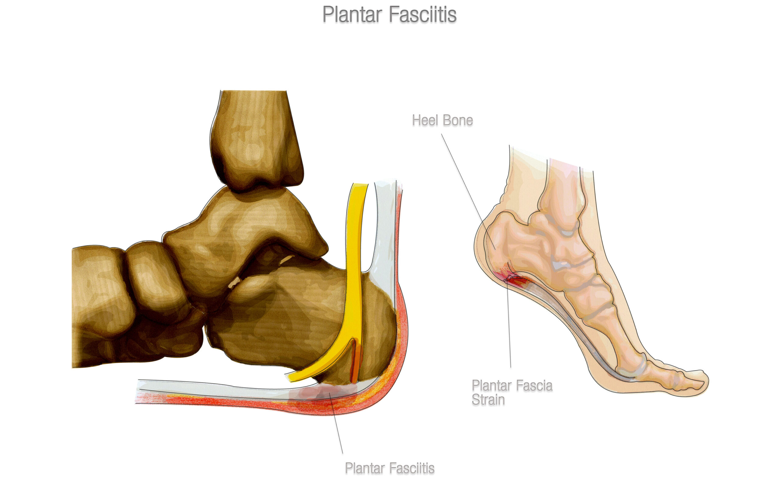 causes of heel pain