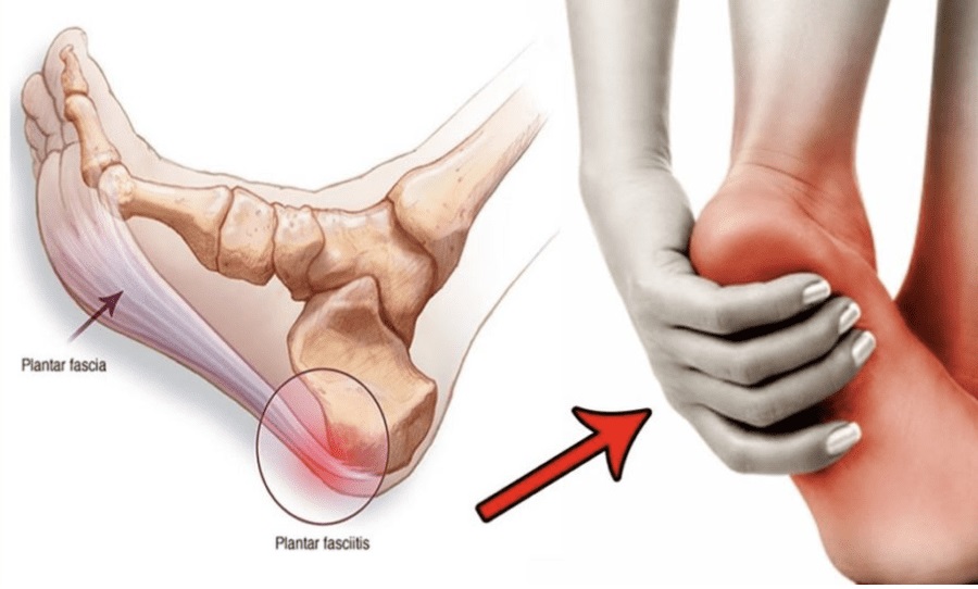 plantar fasciitis to treat with eswt 