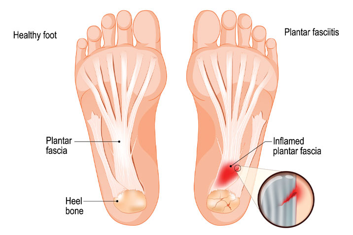 plantar fasciitis example. treated with eswt